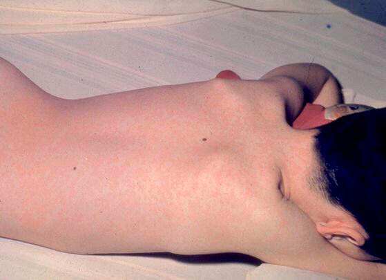 seven year old boy with measles rash on his back