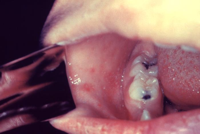 The mouth of a child with measles showing Koplik Spots on the mucosa adjacent to the molars