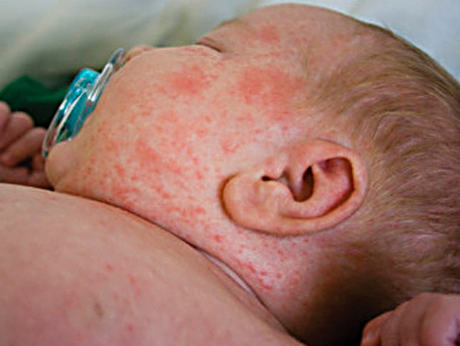 Infant, too young for vaccination, contracting measles from unvaccinated older child.