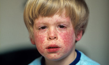 Toddler boy with the measles showing rash on face and circumoral pallor