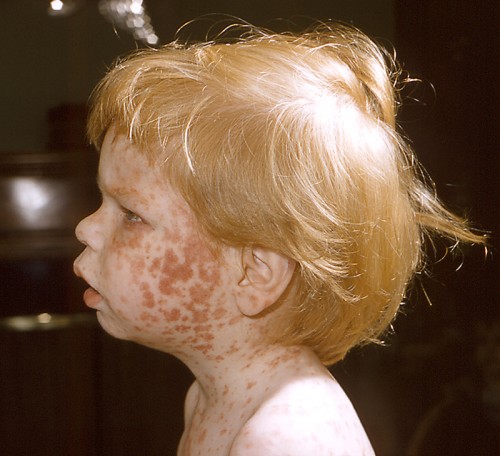 Toddler with facial rash characteristic of Rubella, German Measles or 3-day measles.