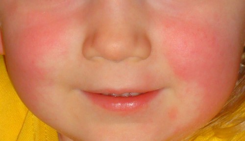 Toddler with scarlet fever showing typical rash on face with circumoral pallor.