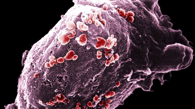 Electron microscope image of HIV virus buds.
