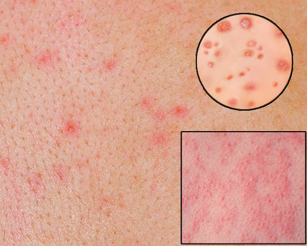 Comparison between rashes: pox, maculopapular, measles