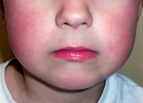 Child with the characteristic "slapped cheek" rash of FIFTH disease.