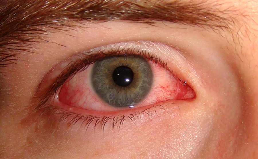 Eye infected with conjunctivitis