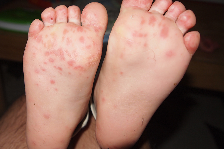 Hand-Foot-Mouth Disease: Feet