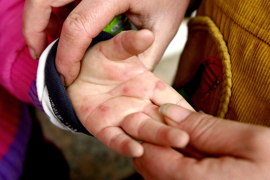 Hand-Foot-Mouth Disease: Hands
