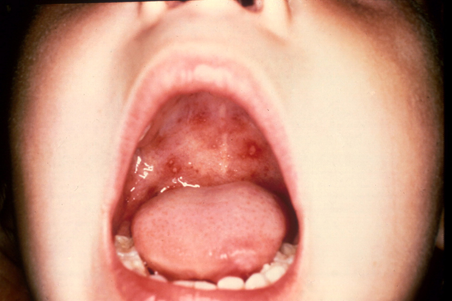 Hand-Foot-Mouth Disease: mouth