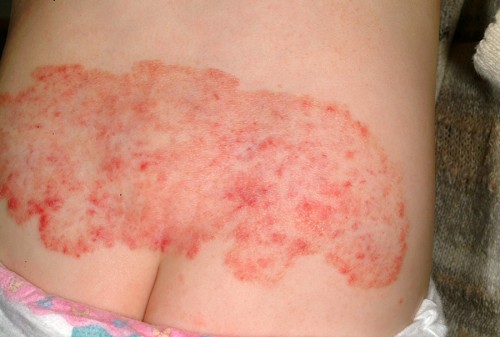 Child with resolving infantile hemangioma on buttocks.