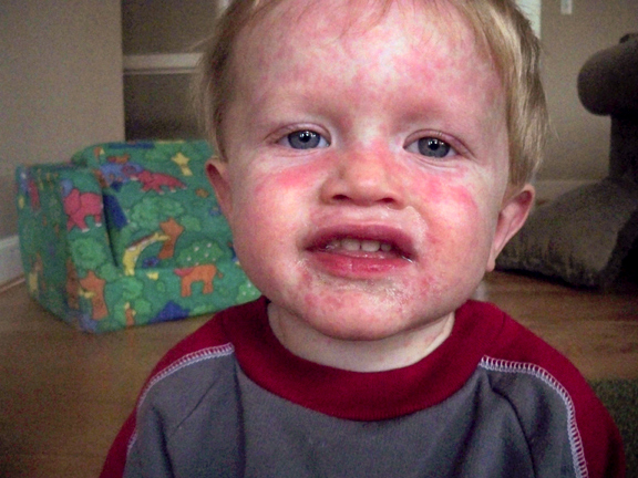 boy with ereythema multiformae rash on face from penicillin