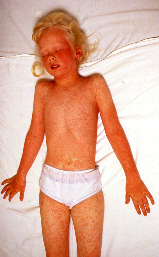 unimmunized girl with measles