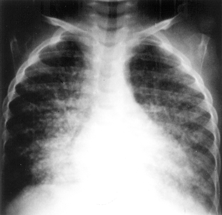 Lung XRay, Measles Interstitial Pneumonitis