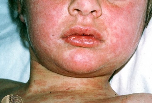 Unimmunized child with measles