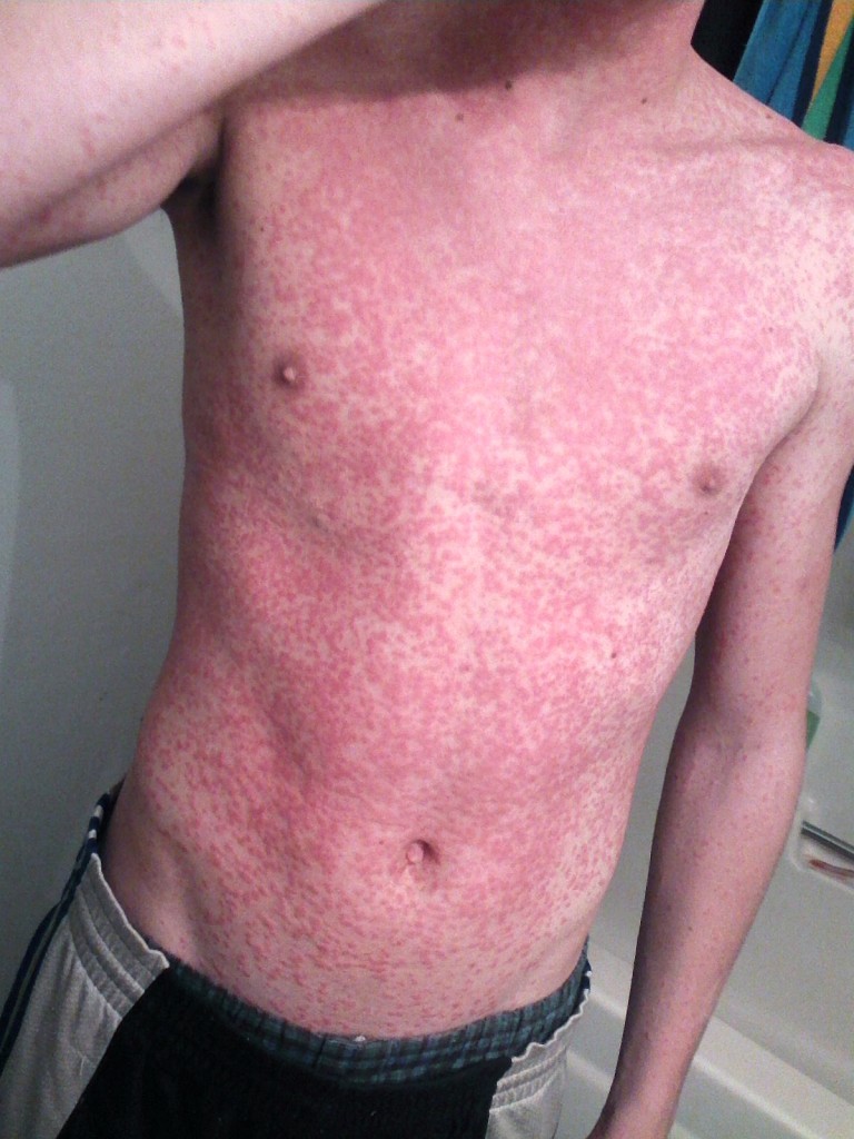 rashes-you-can-diagnose