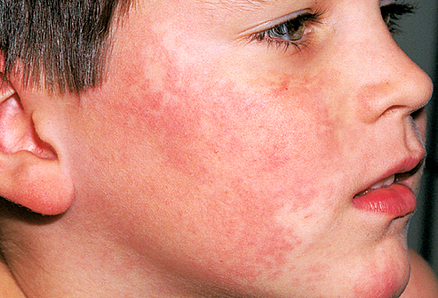 boy with lacey slapped-cheek rash of fifth disease, erythema infectiosum, on face