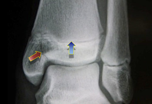 xray of left ankle showing fracture and the growth plate