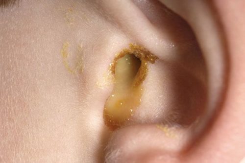A draining ear in an eleven year old boy due to otitis externa