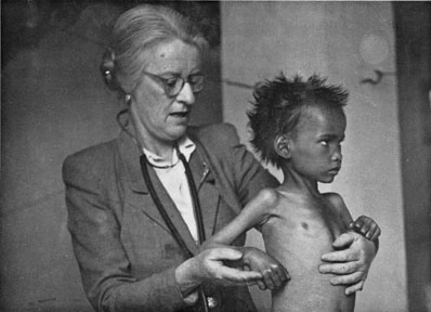 Dr. Cicely D. Williams examines a child with Kwashiorkor, which she discovered