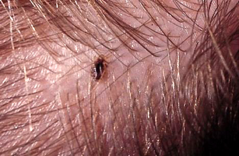 Head Lice - alive, really, really closeup