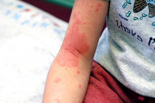 Poison Ivy on a 9-year-old boy