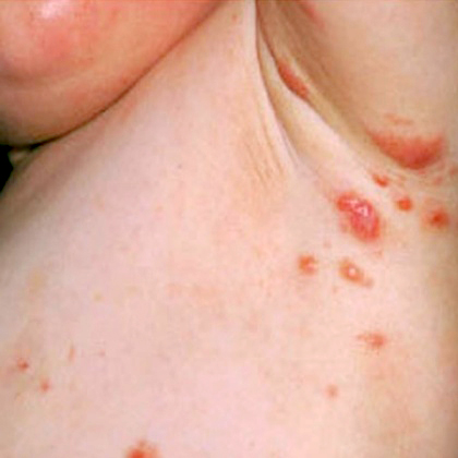 Scabies rash under a childs arm
