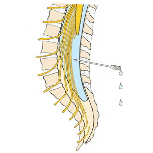 graphic of how a spinal tap is performed