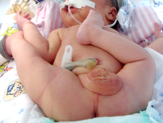 congenital dislocated hip in newborn