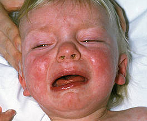 Miserable baby with "measles"