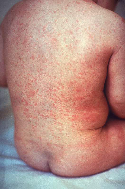 Infant with rash of Rubella - THIRD disease - on his body.