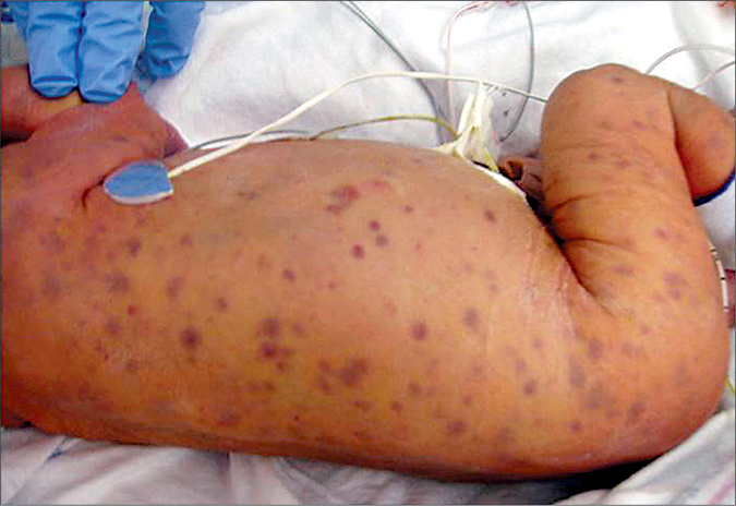 Infant with congenital rubella syndrome showing the "blueberry muffin" skin lesions.