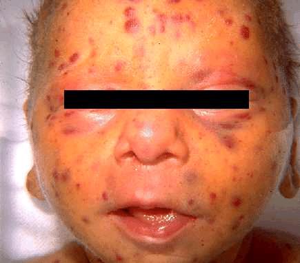 Face of infant with the classic "blueberry muffin" skin lesions of Congenital Rubella Syndrome