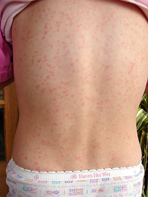 School aged girl with the rash of Scarlet Fever (Scarlatina) on her back