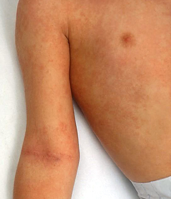 Body rash and pastia's lines of scarlet fever.