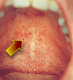 Small red forscheimer dots on the soft palate of a Scarlet Fever patient.