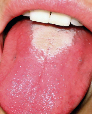 Strawberry tongue of scarlet fever