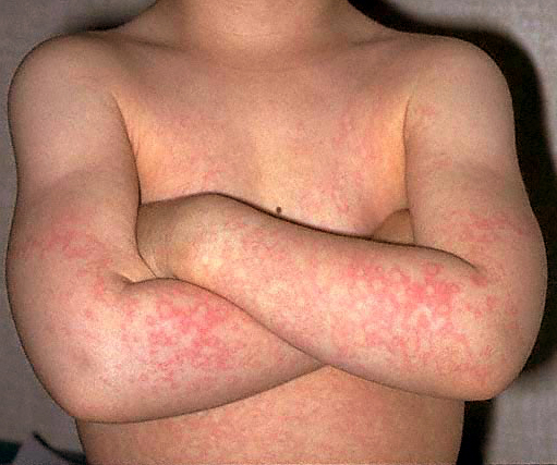 Teenage boy with characteristic rash of FIFTH disease