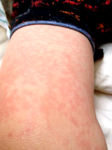 Reticulated. lacy or fenestrated rash of FIFTH disease