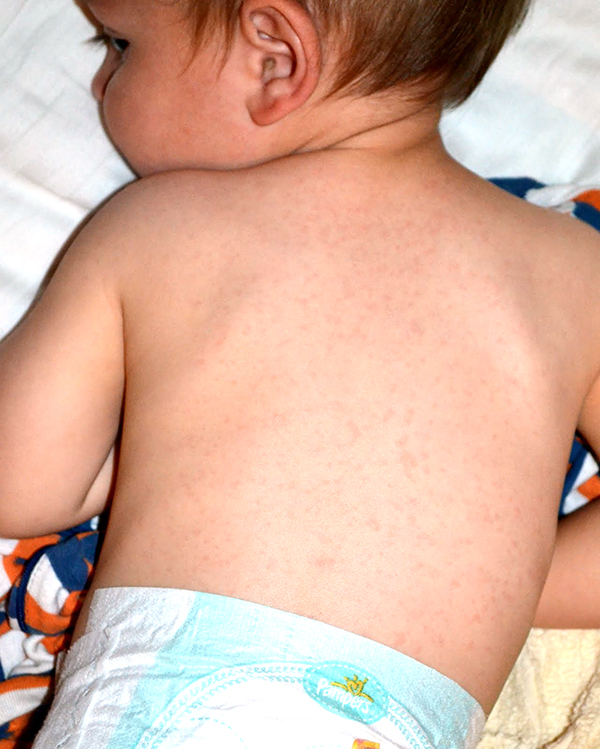 Infant with the rash of Roseola on his back