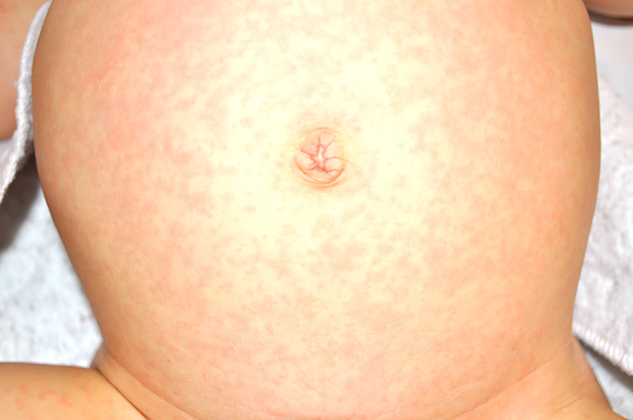 Infant with the "rose-rash" of Roseola on his abdomen.