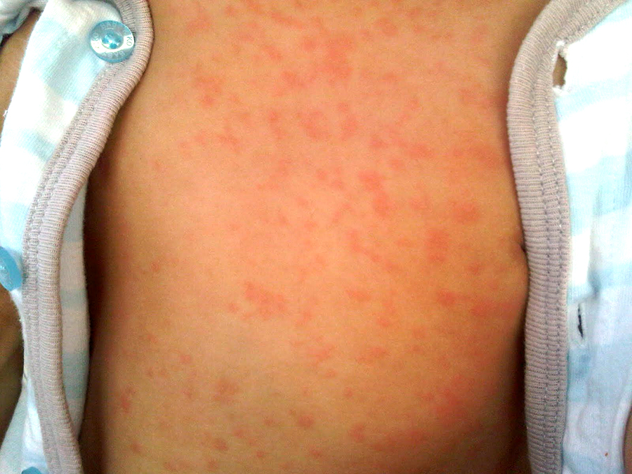 The rash of SIXTH disease, Roseola, on the abdomen of an infant.