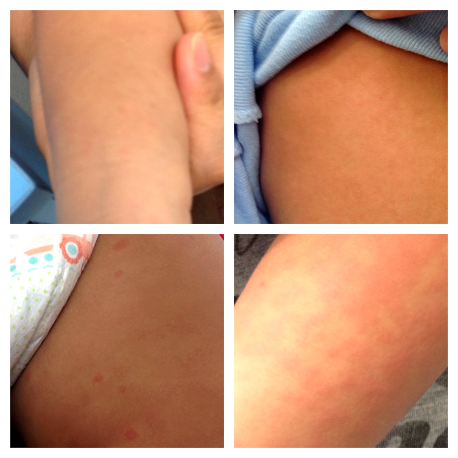 A composite of the rash of 'exanthem subitum,' Roseola, in a child