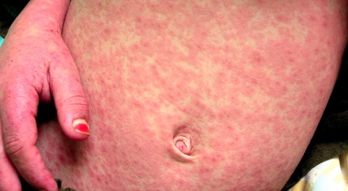 Measles in an unimmunized child