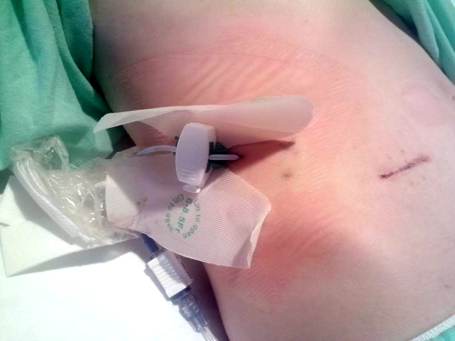 Ruptured appendix with drain for an abcess and small scar at McBurney's point
