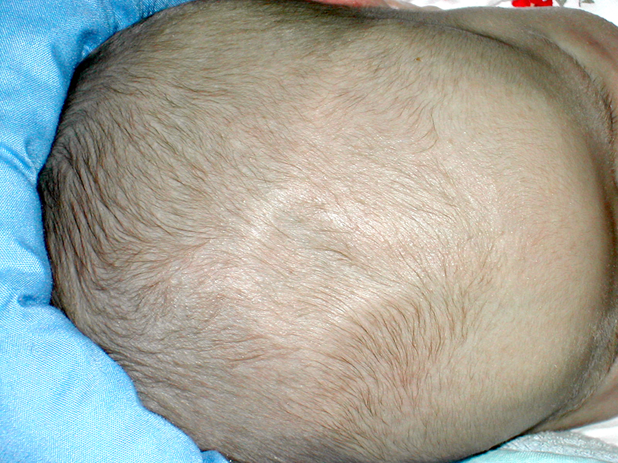 An infant's anterior fontinelle or soft spot