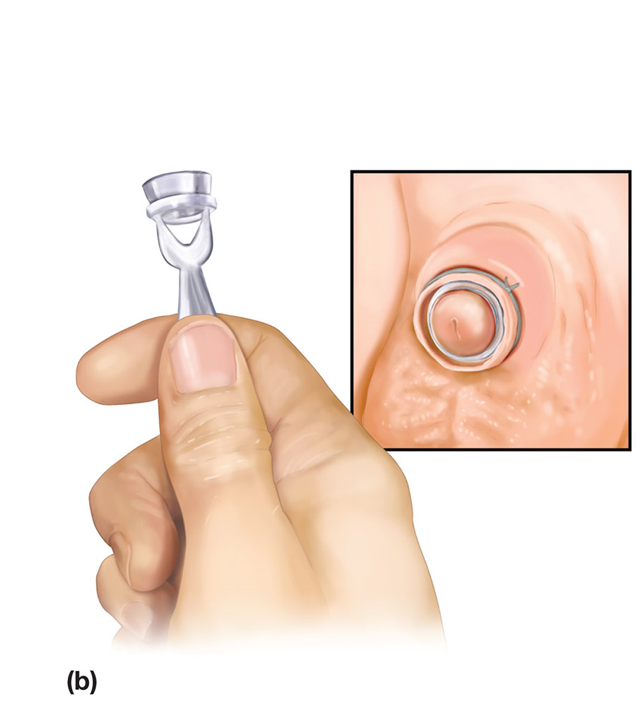 Graphic of circumcision using plastibell