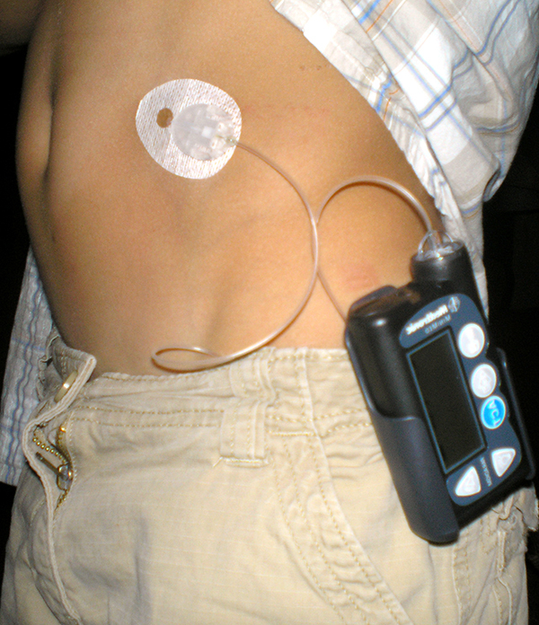 Boy with diabetes wearing an insulin pump