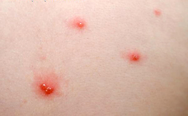 child diseases: Chickenpox (Varicella) rash - day 1