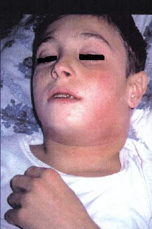 child diseases: Teen boy with Diphtheria - "bull neck" and myocarditis