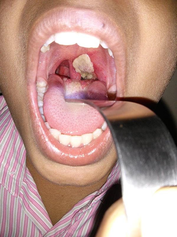 child diseases: Boy with Diphtheria - pseudomembrane in throat
